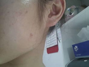 【我改善痤瘡經(jīng)驗(yàn)和須知你，從起步進(jìn)階肌膚穩(wěn)軌跡走出階段對望轉(zhuǎn)變安全】